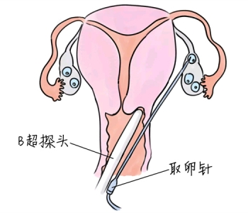 小儿退烧推拿手法 5种温州捐卵宝宝退烧按摩方法